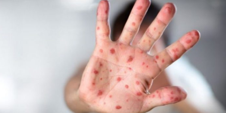 Në 3 muaj 12 fëmijë të prekur nga fruthi/ ISHP: Janë të pavaksinuar