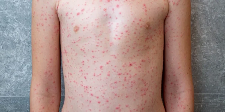 ‘Angazhim në luftën kundër fruthit’, OBSH: Është përhapur në 58 shtete