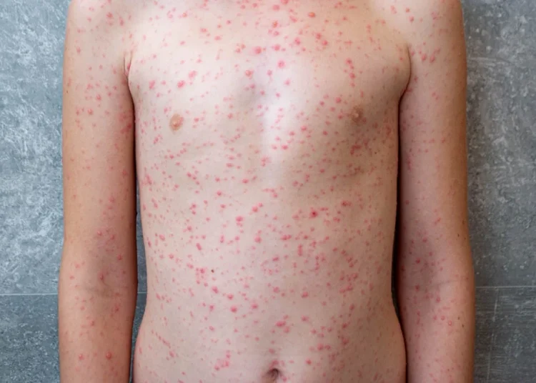 ‘Angazhim në luftën kundër fruthit’, OBSH: Është përhapur në 58 shtete